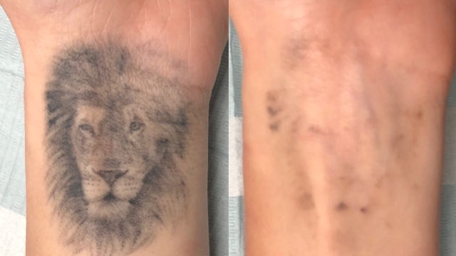 Tattoo Removal Options – What Options Do Include
