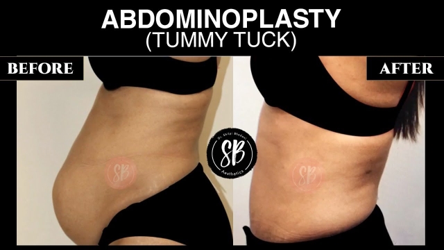 Flatten Your Belly, Enhance Your Confidence: The Ultimate Guide to Abdominoplasty