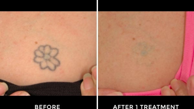 Avoid Tattoo Removal Acquiring The Perfect Tattoo!