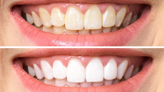 Sparkling Smiles: Unleashing the Power of Teeth Whitening