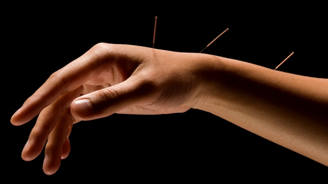 The Art of Balancing Body and Mind: Exploring the Wonders of Acupuncture