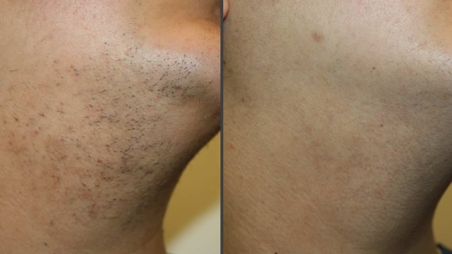 Reveal Your Smoothest Skin: The Ultimate Guide to Laser Hair Removal