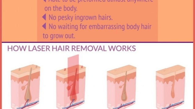 Forever Smooth: Unlocking the Secrets of Laser Hair Removal